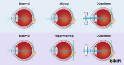 Göz Kusurları, miyop ve hipermetrop